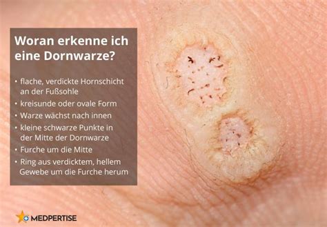 dornwarze schwarzer punkt